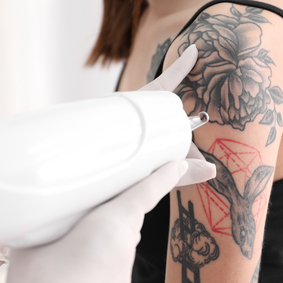 Tattoo Removal - Skin Care Physicians