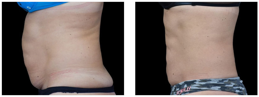 Patient #10350 Body Contouring Before and After Photos Beverly