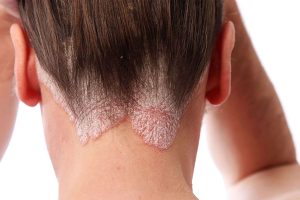 psoriasis on upper neck of patient