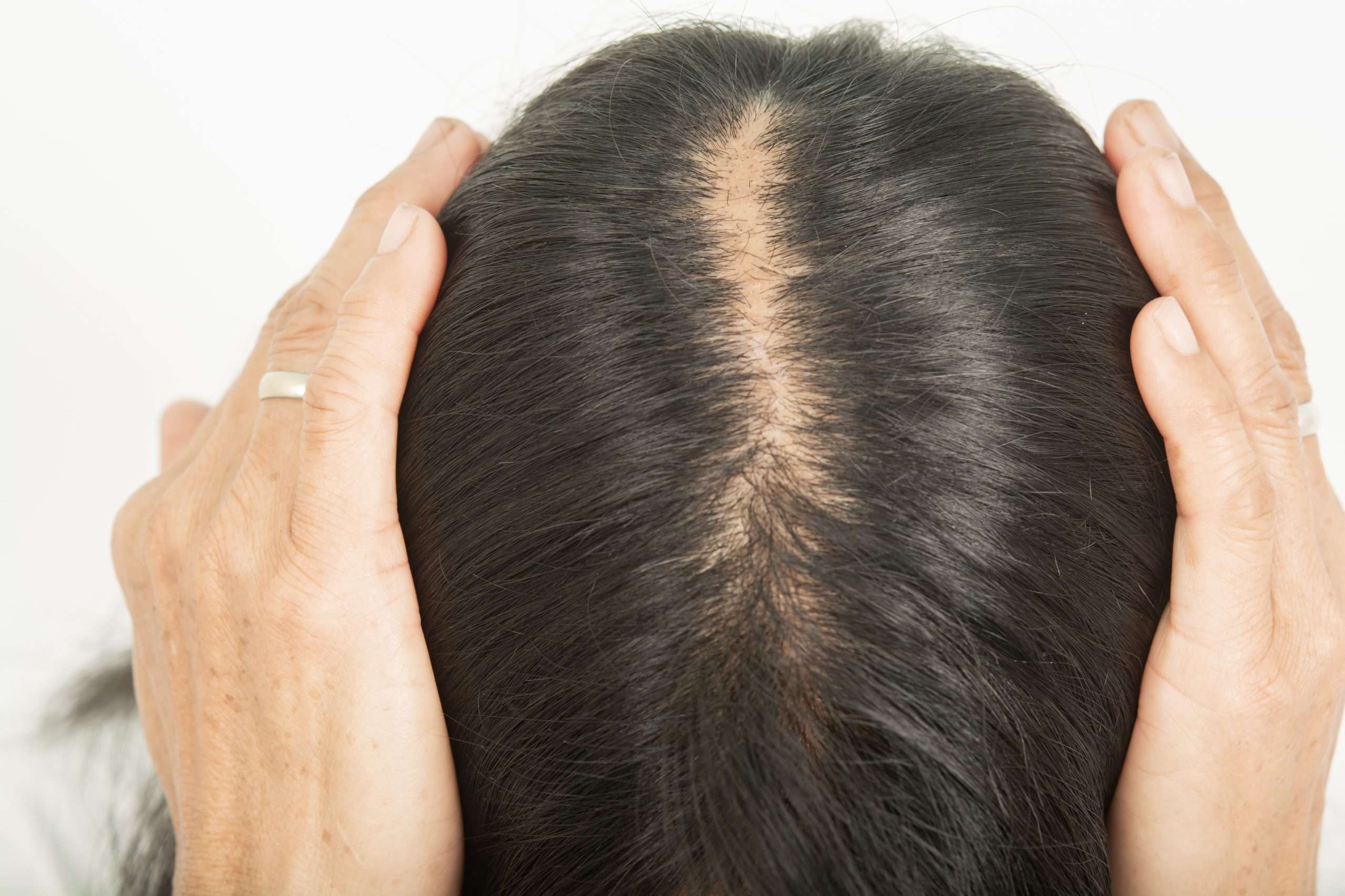 Hair Loss Treatment - Skin Care Physicians