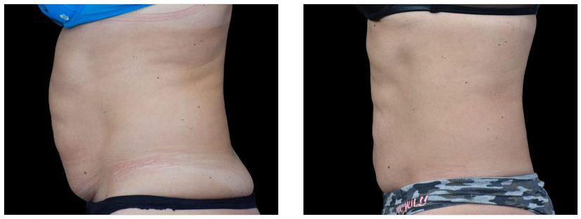 Body Contouring Before and After 