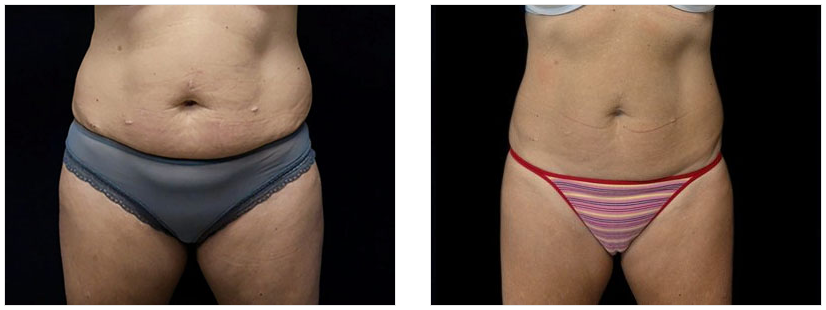 liposuction procedure before and after