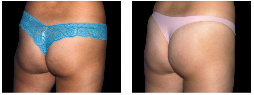 macon women liposuction before and after