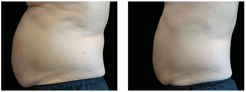 macon man liposuction before and after