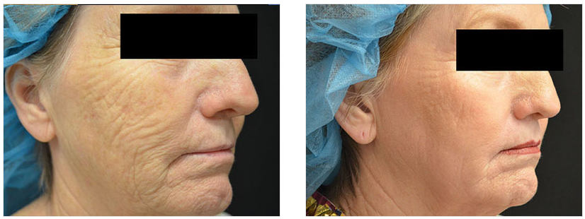 Macon Acne Treatment