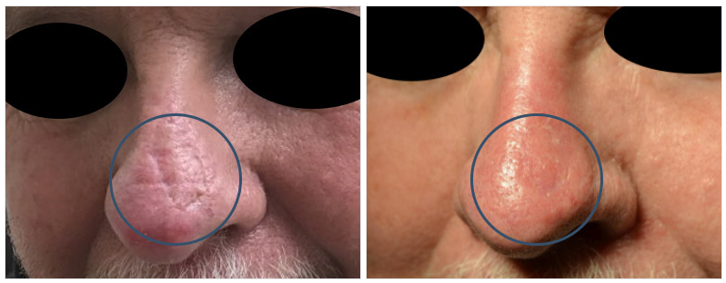 Acne Treatment in Macon