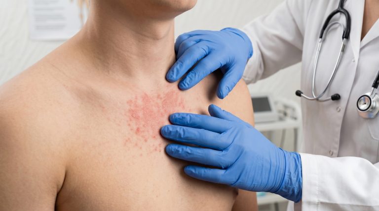 Dermatologist examines red skin rash on patient chest in clinical office setting with blue medical gloves and stethoscope